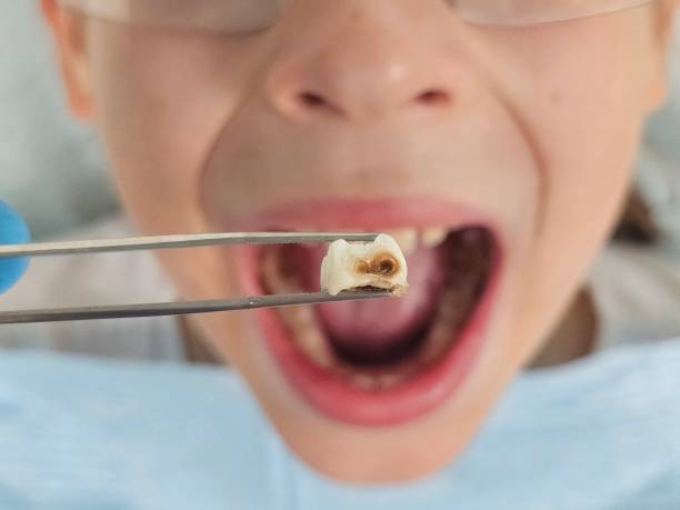 Best Emergency Tooth Extraction in Williamstown, PA
